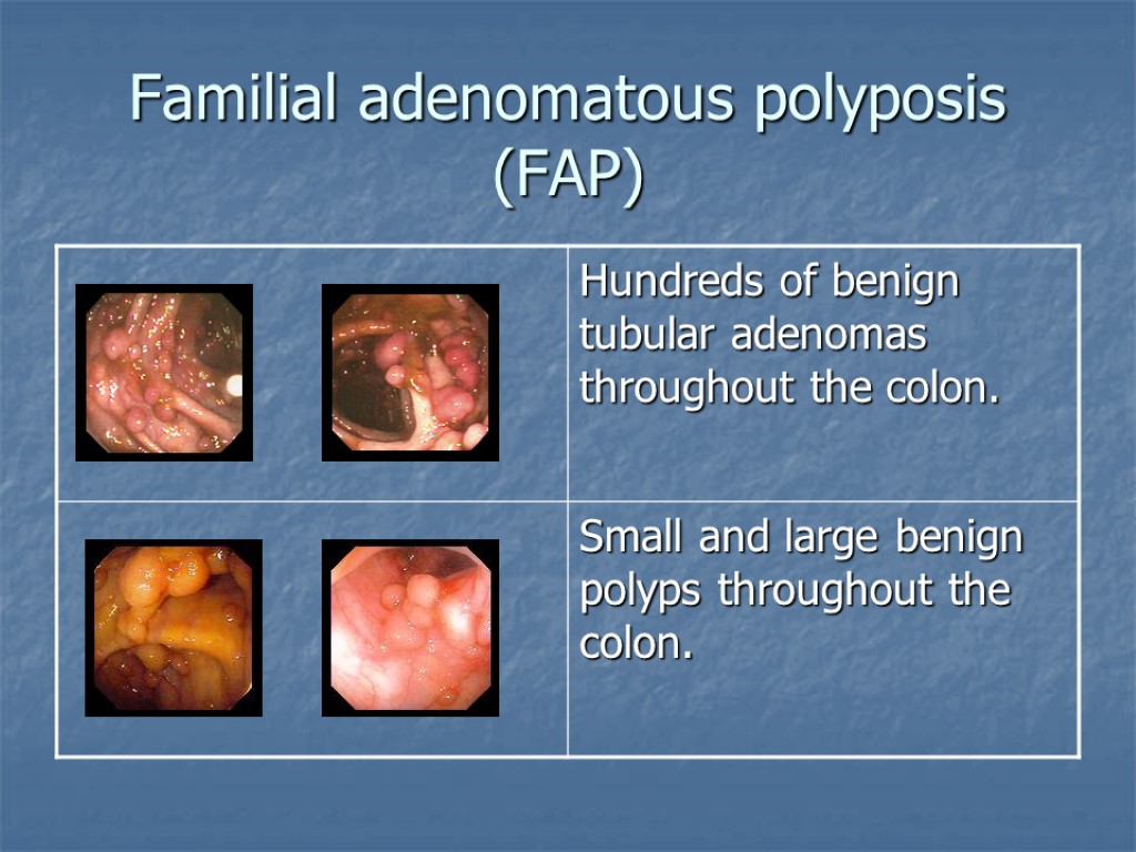 Familial adenomatous polyposis (FAP)